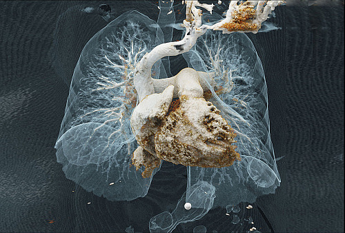 CT angiografie srdce a plic – Plicní embolie