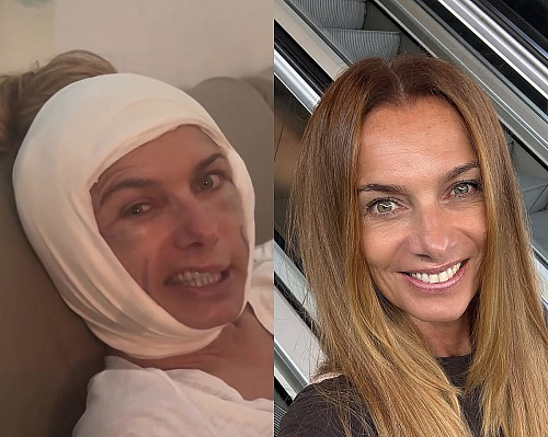Alice Bendová vyděsila fanoušky obličejem s podlitinami. (2. září 2026)