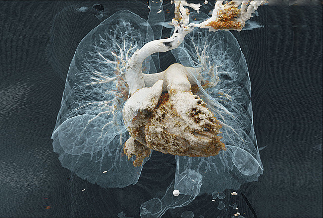 CT angiografie srdce a plic – Plicní embolie